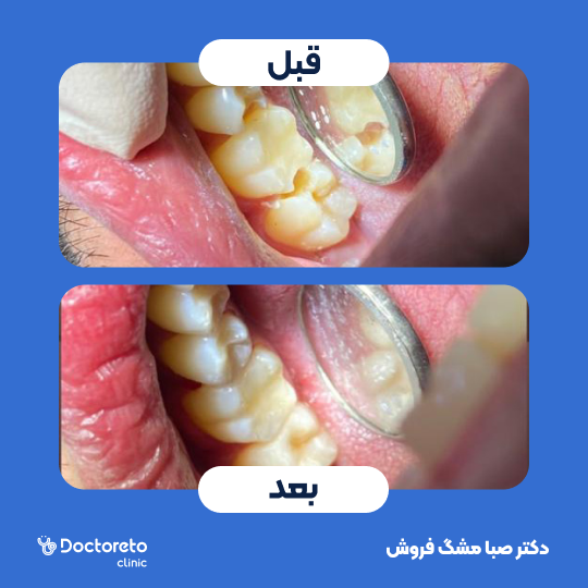 پر کردن دندان⬅️ دکتر صبا مشگ فروش در اصفهان 1