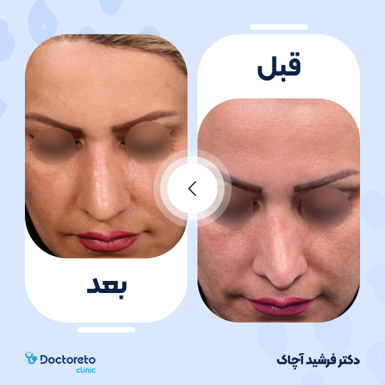 عمل جراحی ترمیمی زیبایی بینی (رینوپلاستی)