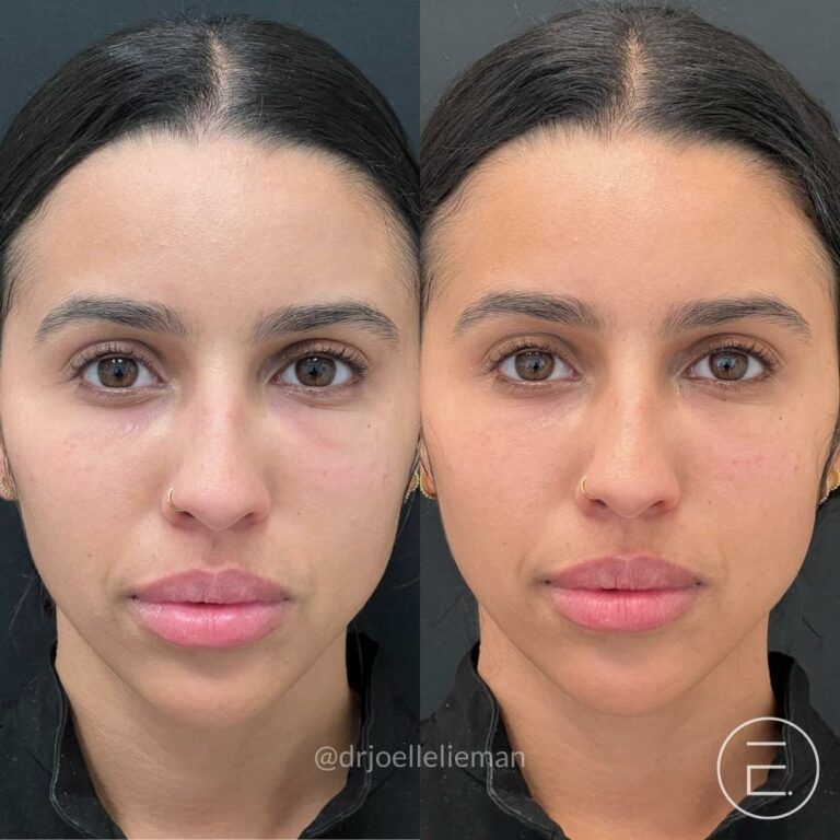 تزریق ژل زیر چشم