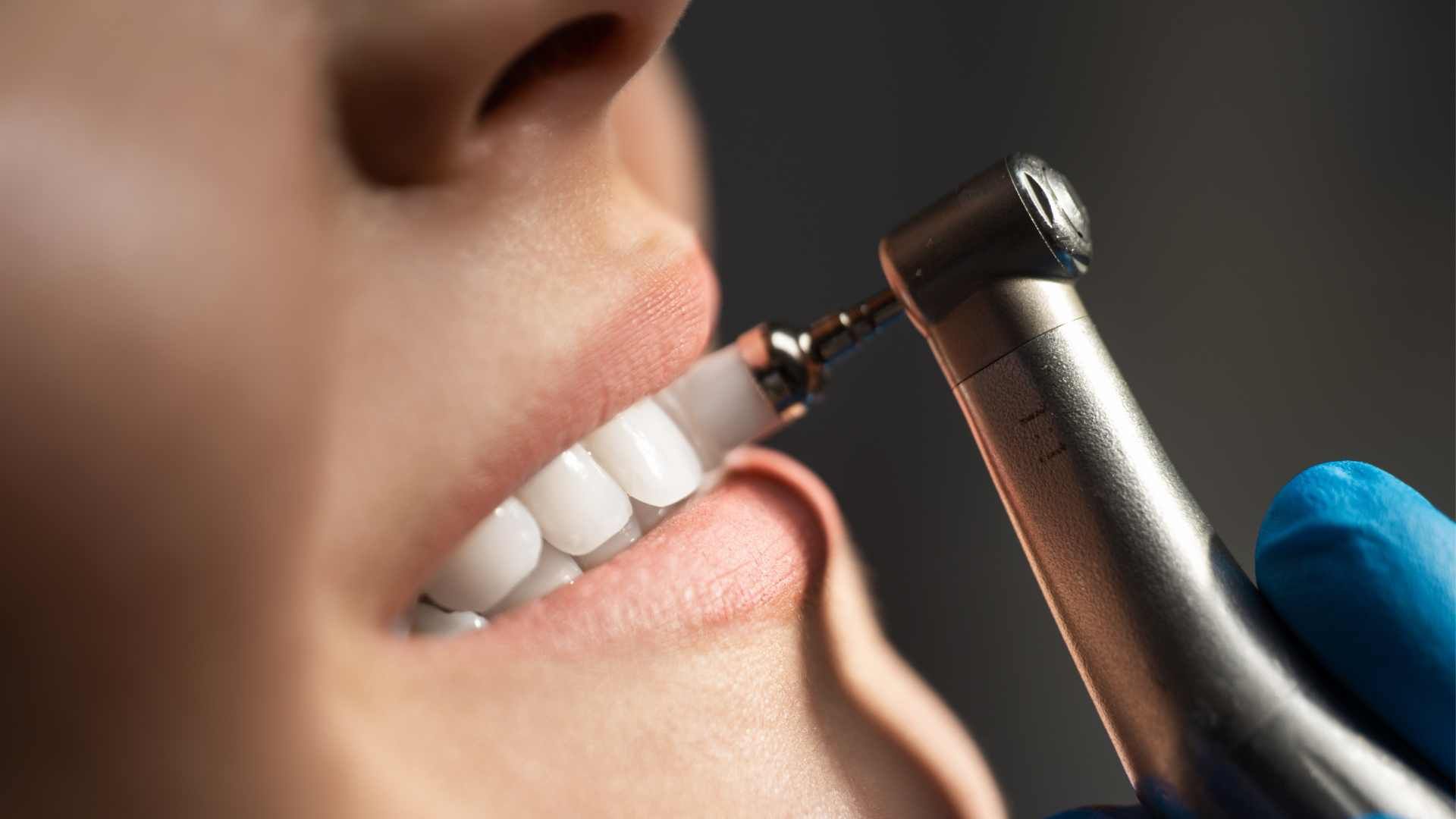 جرم گیری کامل دندان‌های دو فک با بروساژ