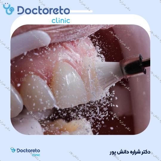 جرم گیری کامل دندان‌های دو فک با بروساژ