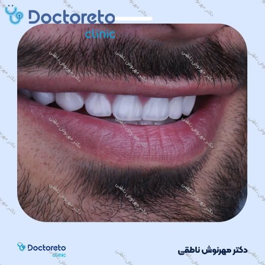 لمینت دندان (هر واحد)