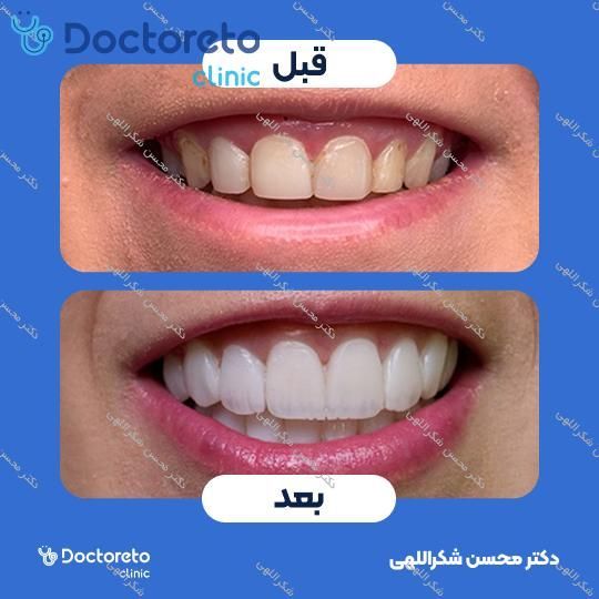 جرم گیری کامل دندان‌های دو فک با بروساژ