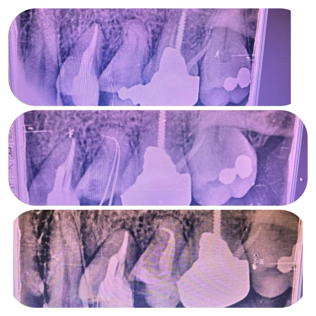 عصب کشی 2 کانال