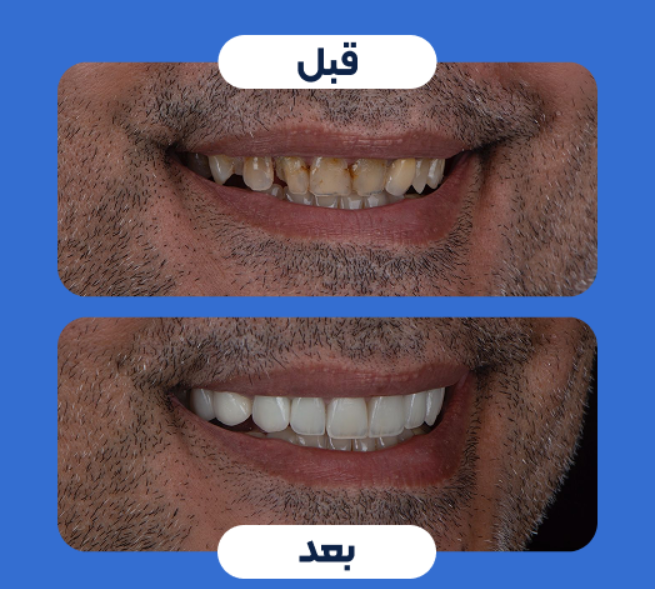 لمینت سرامیکی و روکش ایمکس آلمان (هر واحد)