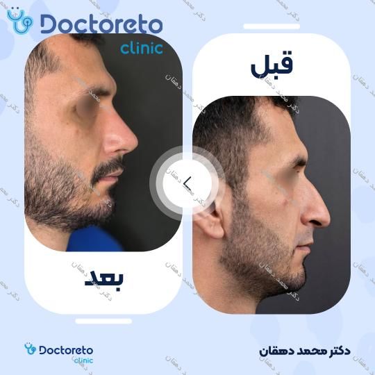 عمل جراحی بینی (رینوپلاستی)