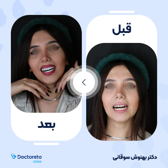 ونیر کامپوزیت (هر واحد)