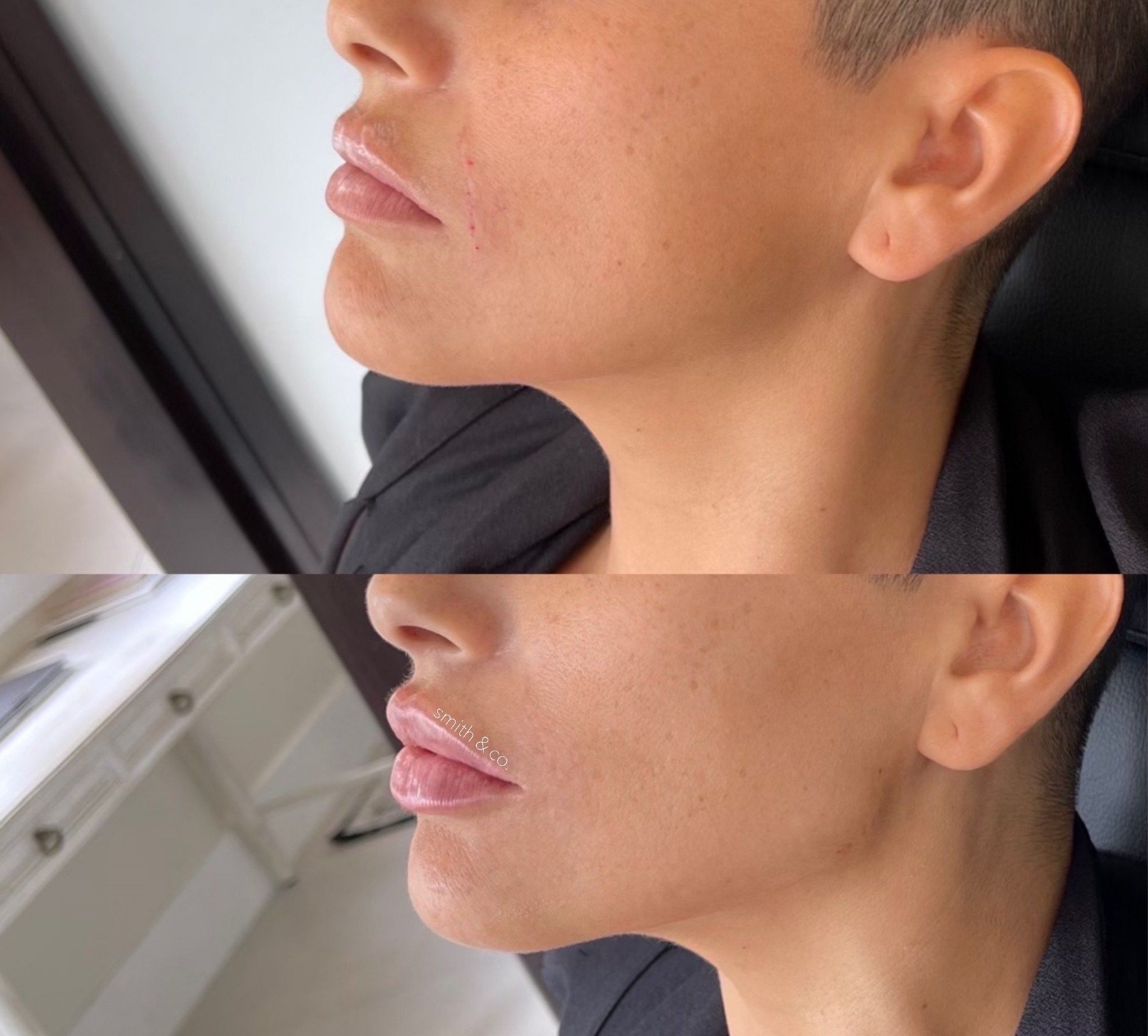 تزریق ژل زاویه فک