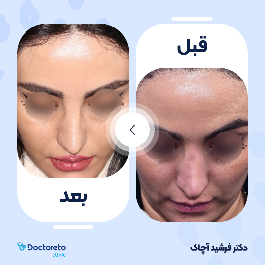 عمل جراحی ترمیمی زیبایی بینی (رینوپلاستی)