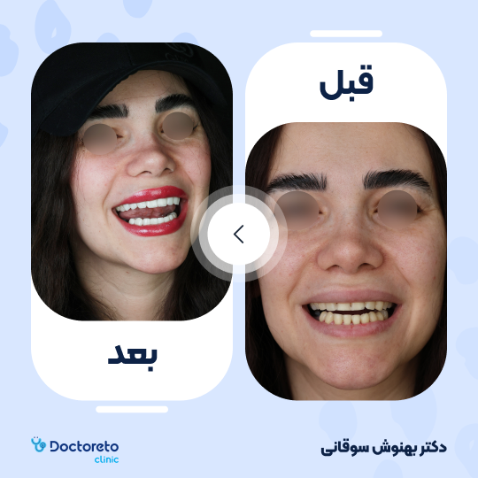 ونیر کامپوزیت (هر واحد)