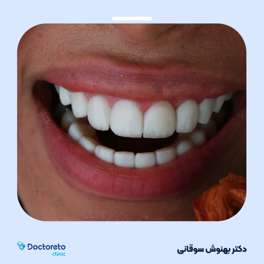 لمینت دندان با برند آی پی اس ایمکس (هر واحد)