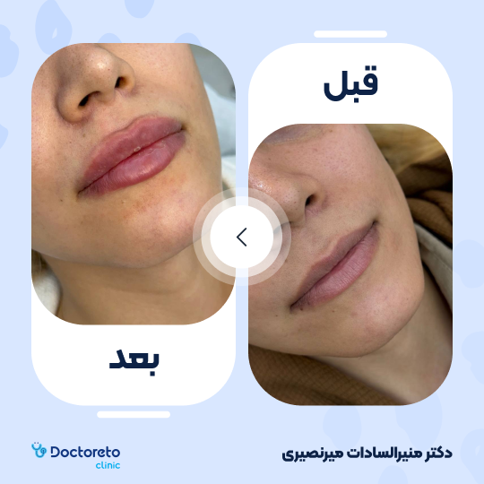 تزریق ژل لب