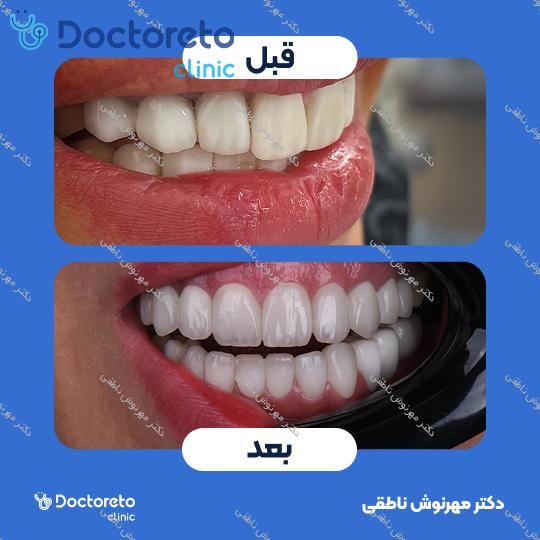 لمینت دندان (هر واحد)