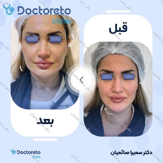 تزریق ژل زاویه فک