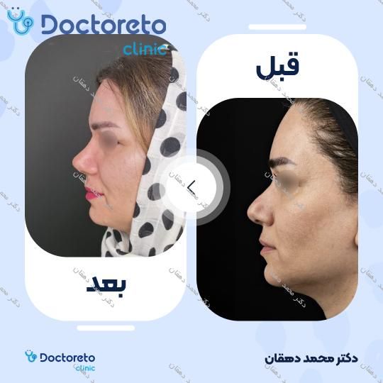 عمل جراحی مجدد بینی (رینوپلاستی)