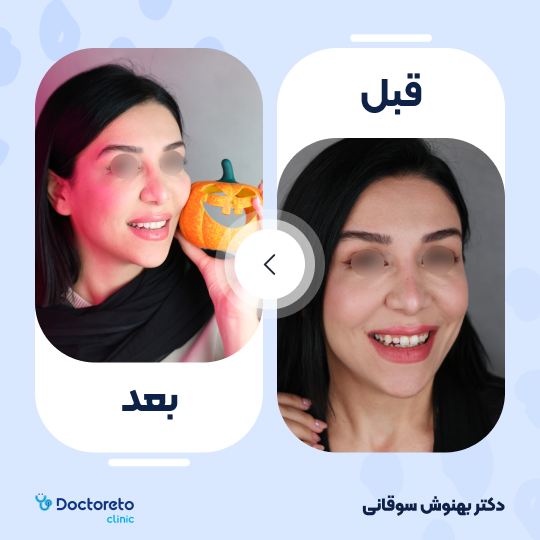 کامپوزیت تکه ای(اصلاح و طراحی لبخند) (هرواحد)