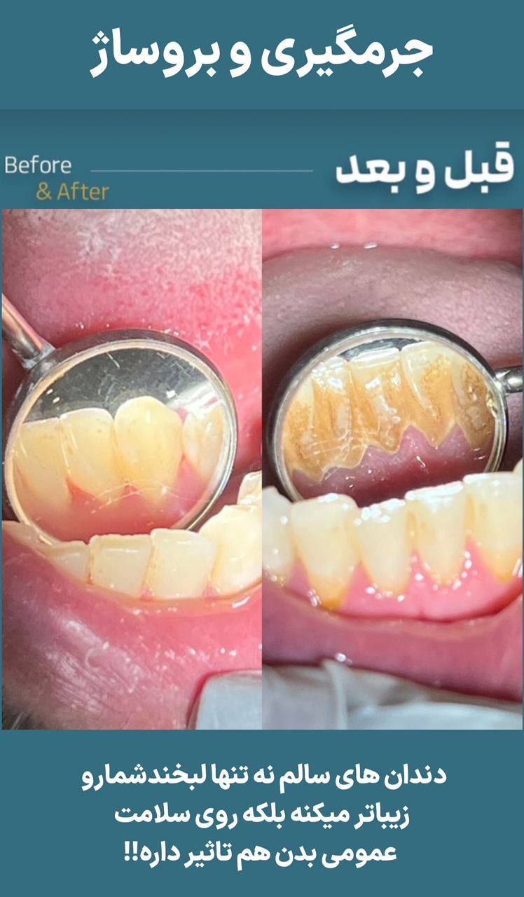 جرم گیری کامل دندان‌های دو فک با بروساژ🦷