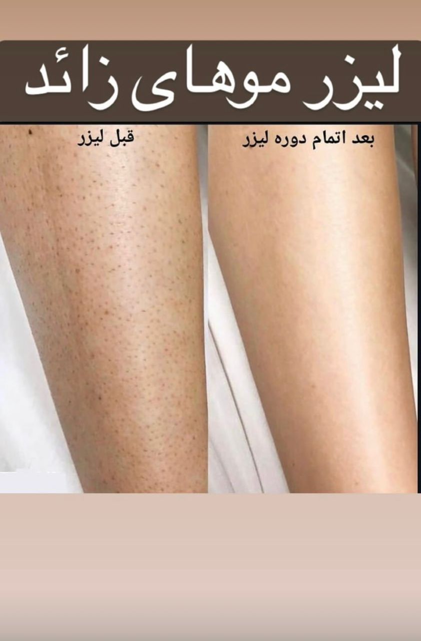 لیزر موهای زائد بانوان وآقایان با دستگاه ریوکسی⚡