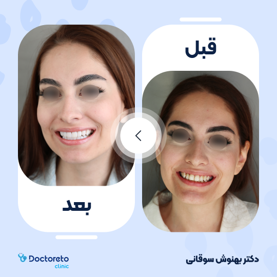 ونیر کامپوزیت (هر واحد)