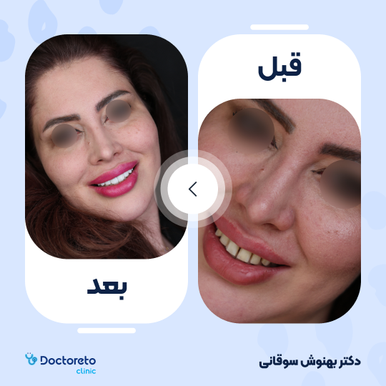 ونیر کامپوزیت (هر واحد)