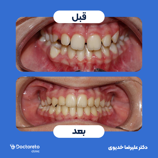 ارتودنسی ثابت فلزی