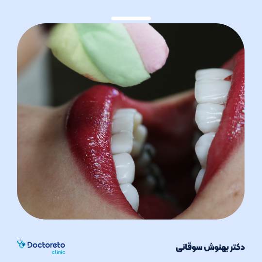 ونیر کامپوزیت (هر واحد)