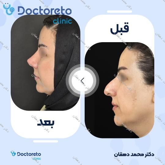 عمل جراحی بینی (رینوپلاستی)