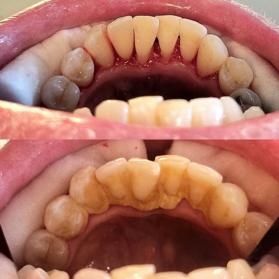 جرم گیری کامل دندان‌های دو فک با بروساژ🦷