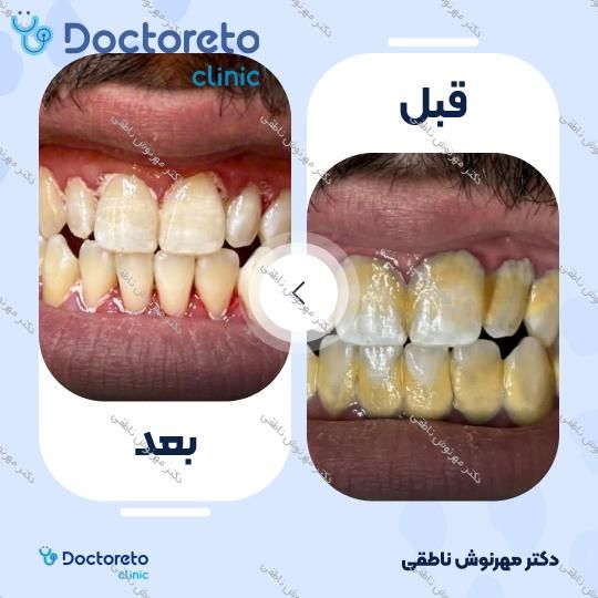 جرم گیری کامل دندان‌های دو فک با بروساژ🦷