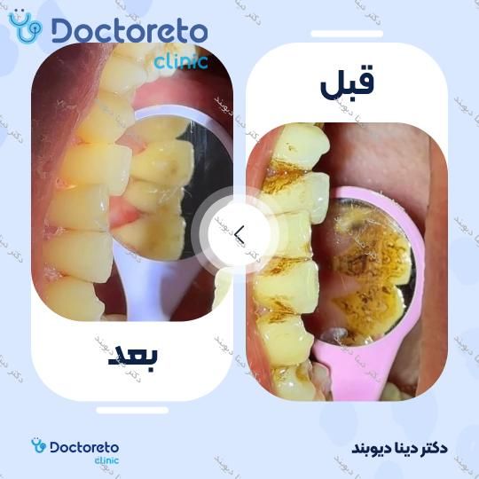 جرم گیری کامل دندان‌های دو فک با بروساژ