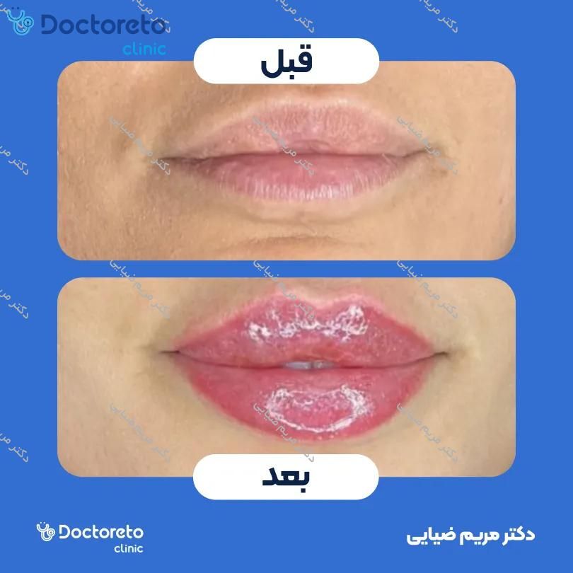 تزریق ژل لب