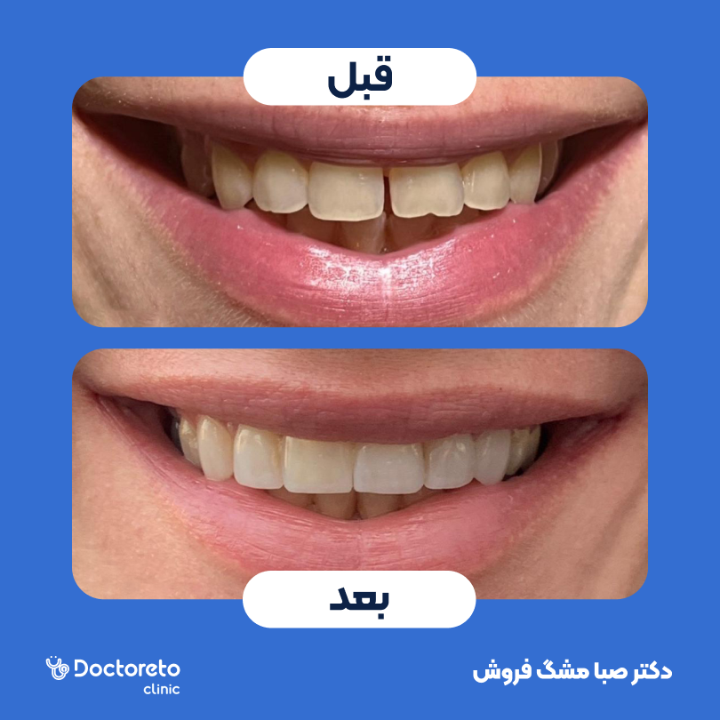 ونیر کامپوزیت (هر واحد)⬅️ دکتر صبا مشگ فروش در اصفهان 1