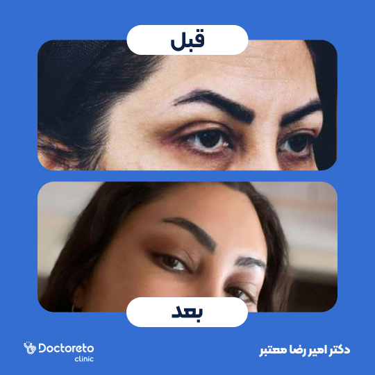 بلفاروپلاستی به روش جراحی