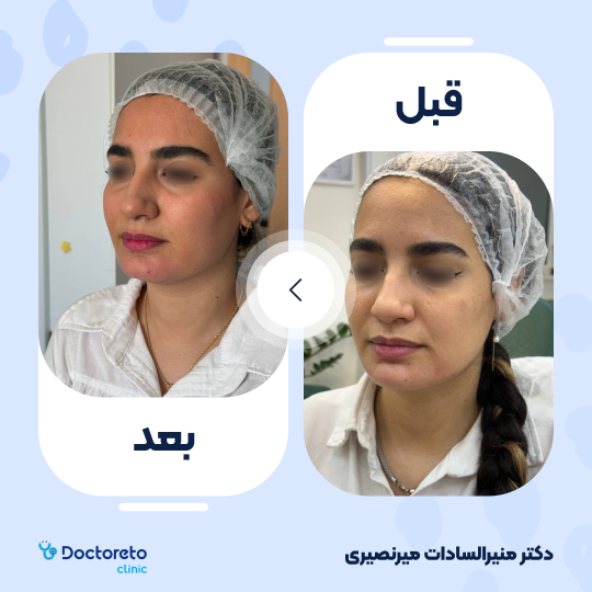 تزریق ژل چانه