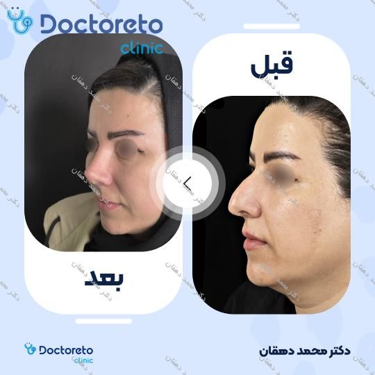 عمل جراحی مجدد بینی (رینوپلاستی)