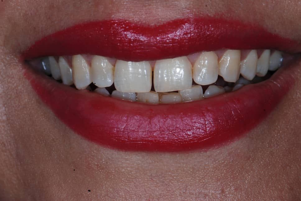 بلیچینگ دندان (سفید کردن دندان)