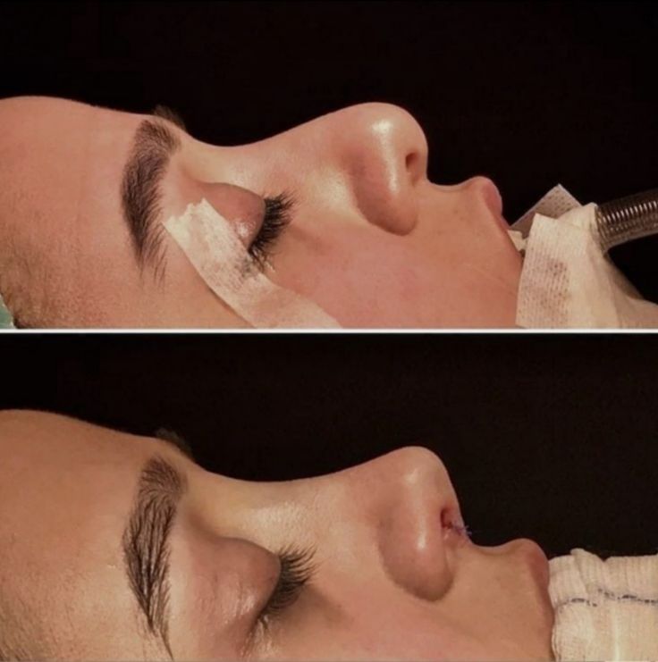 عمل زیبایی بینی (رینوپلاستی)