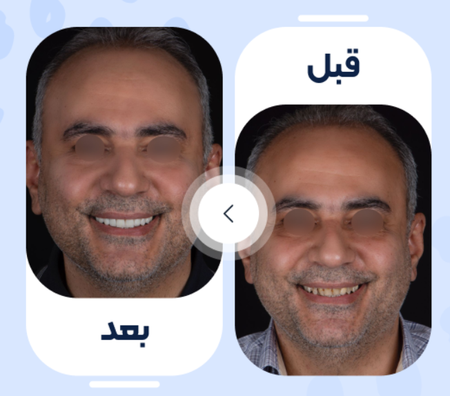 لمینت سرامیکی و روکش ایمکس آلمان (هر واحد)