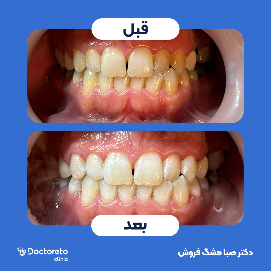 هوم بلیچینگ (سفید کردن دندان) دو فک با مواد آمریکایی