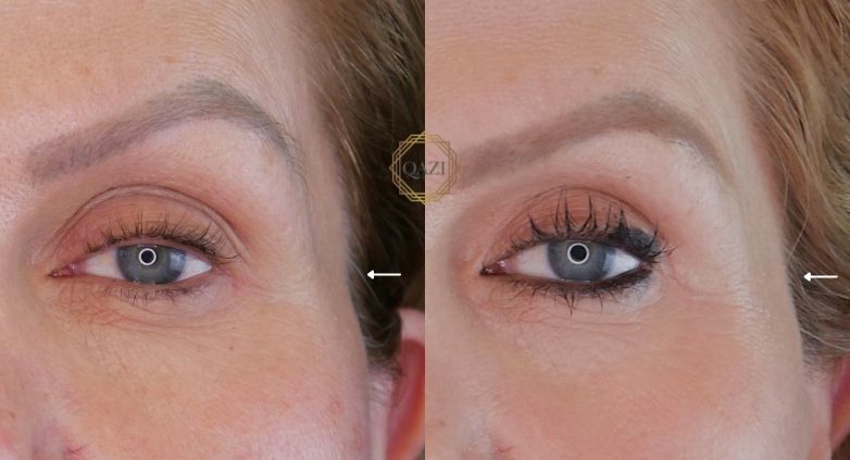 تزریق ژل شقیقه