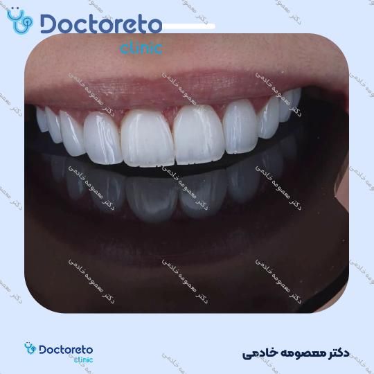 لمینت دندان (هر واحد)