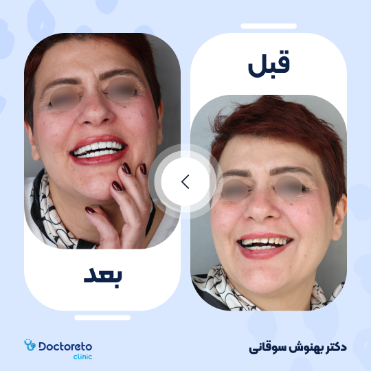 ونیر کامپوزیت (هر واحد)