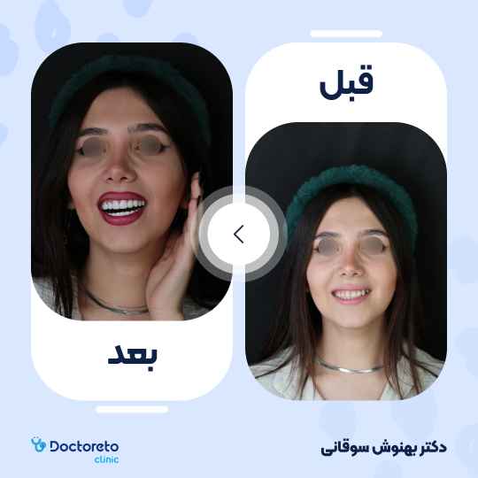 ونیر کامپوزیت (هر واحد)