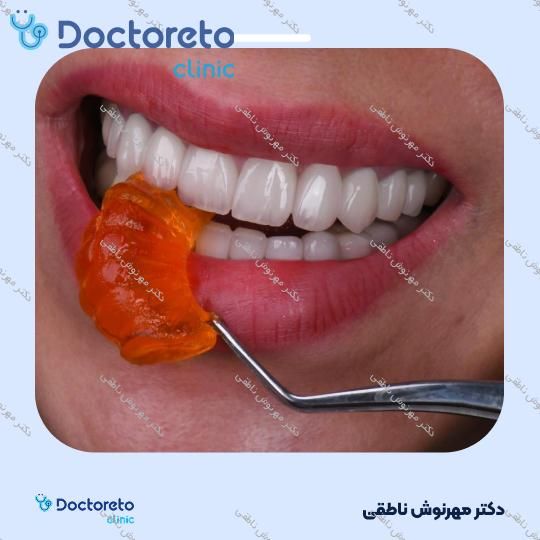 لمینت دندان (هر واحد)