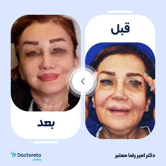 بلفاروپلاستی به روش جراحی