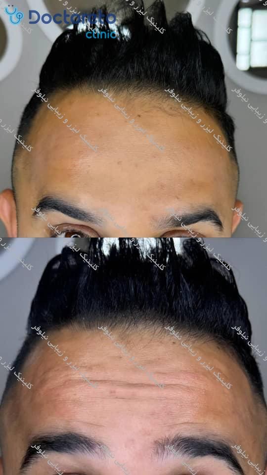 تزریق بوتاکس صورت (پیشانی، خط اخم، پنجه کلاغی)💉