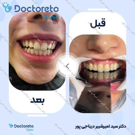 جرم گیری کامل دندان‌های دو فک با بروساژ