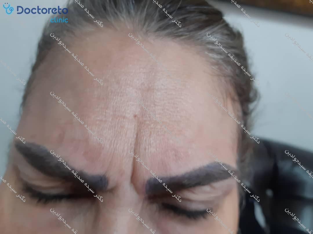 تزریق بوتاکس صورت (پیشانی، خط اخم، پنجه کلاغی)💉