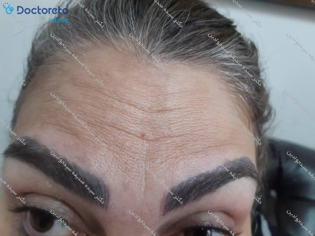 تزریق بوتاکس صورت (پیشانی، خط اخم، پنجه کلاغی)💉