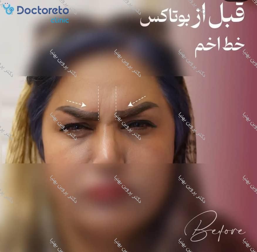 تزریق بوتاکس صورت (پیشانی، خط اخم، پنجه کلاغی)💉